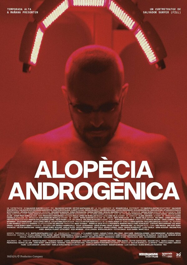 Постер Alopècia androgènica